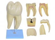 磨牙蛀牙解剖放大模型