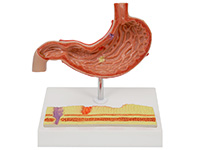 病理胃模型（胃炎模型）