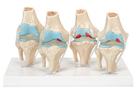 膝关节健康病态比较模型 4阶段膝关节病变模型