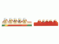牙周病模型 牙周病分类模型